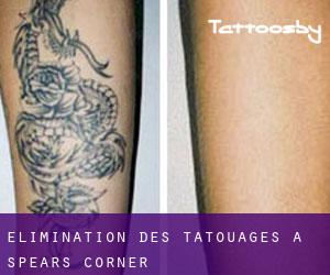 Élimination des tatouages à Spears Corner