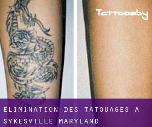 Élimination des tatouages à Sykesville (Maryland)