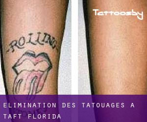 Élimination des tatouages à Taft (Florida)