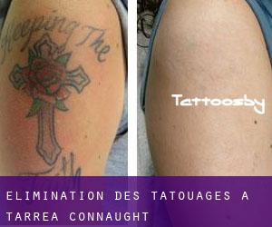 Élimination des tatouages à Tarrea (Connaught)