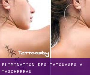 Élimination des tatouages à Taschereau