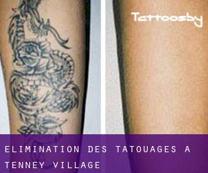 Élimination des tatouages à Tenney Village