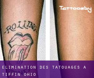 Élimination des tatouages à Tiffin (Ohio)