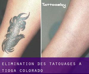 Élimination des tatouages à Tioga (Colorado)
