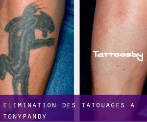 Élimination des tatouages à Tonypandy