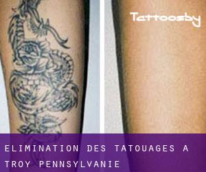 Élimination des tatouages à Troy (Pennsylvanie)