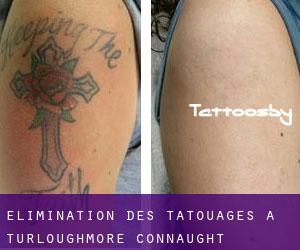 Élimination des tatouages à Turloughmore (Connaught)