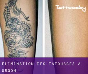 Élimination des tatouages à Urgon