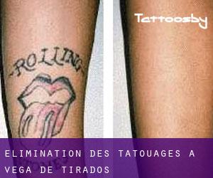 Élimination des tatouages à Vega de Tirados