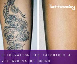 Élimination des tatouages à Villanueva de Duero