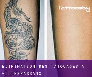 Élimination des tatouages à Villespassans