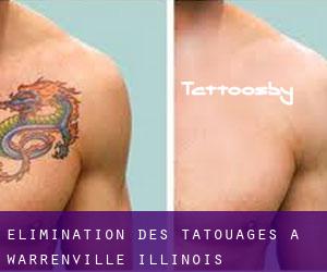 Élimination des tatouages à Warrenville (Illinois)