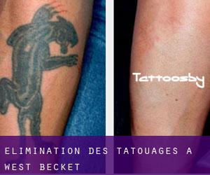 Élimination des tatouages à West Becket