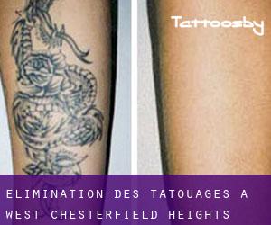 Élimination des tatouages à West Chesterfield Heights